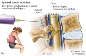 Transforaminal Epidural Steroid Injection