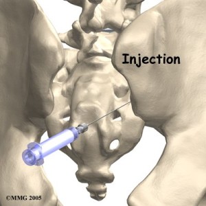SI Joint Injection